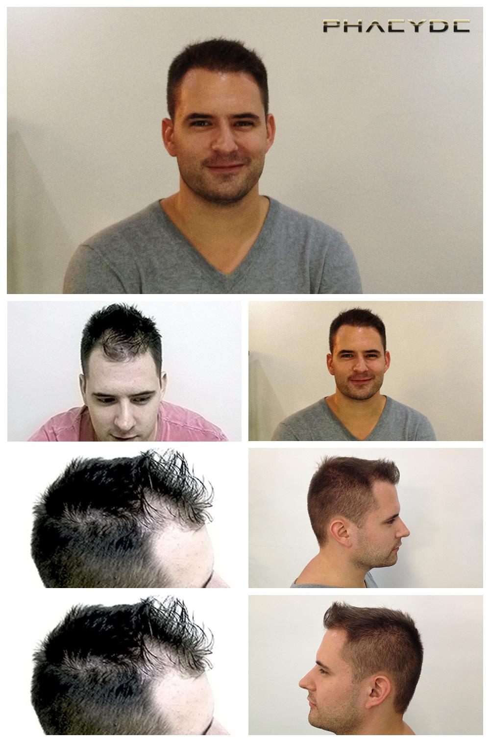Fue&nbsp;hair recovery&nbsp;before&nbsp;after&nbsp;pictures&nbsp