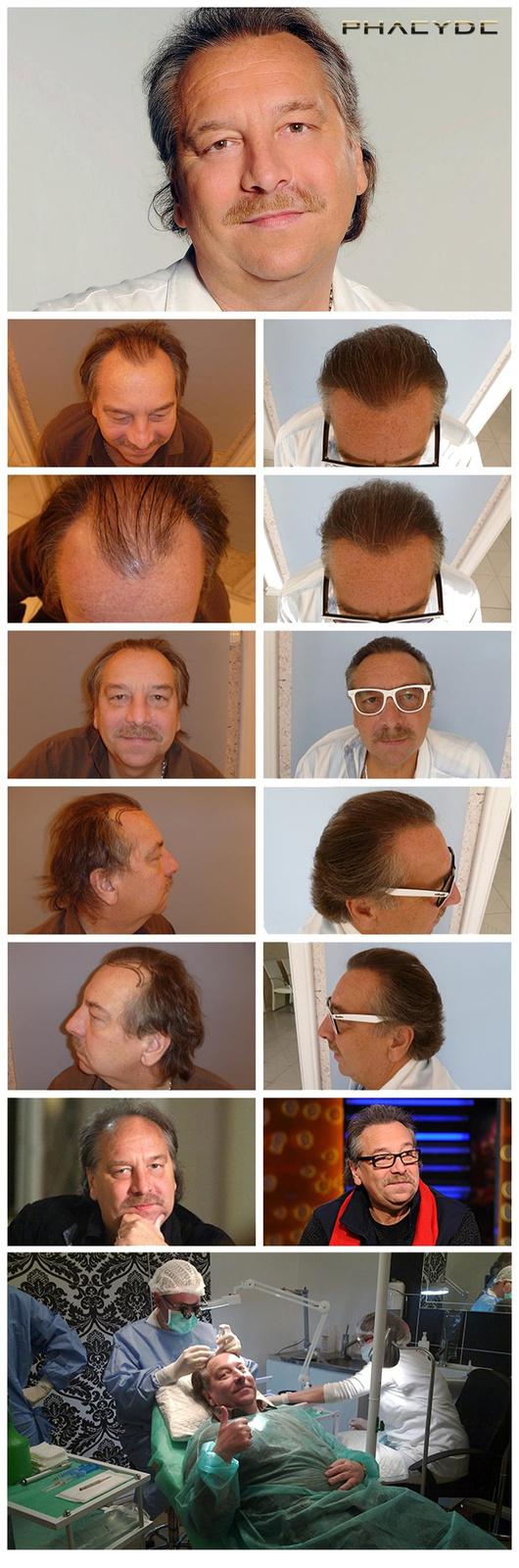 Hair transplant&nbsp;results&nbsp;photos&nbsp;of&nbsp;many&nbsp;