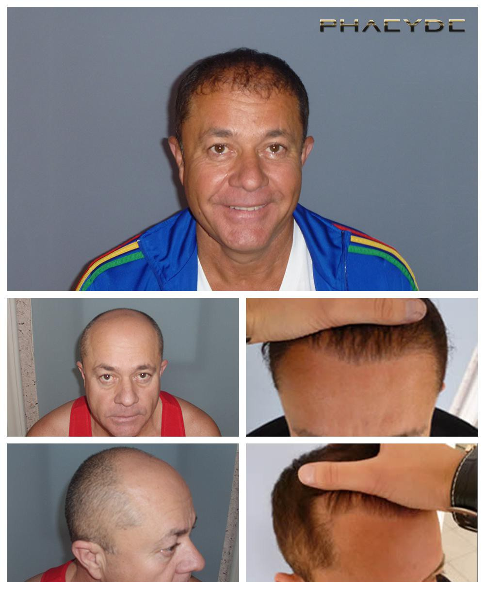 Hair transplant&nbsp;before&nbsp;after&nbsp;result&nbsp;photos&n