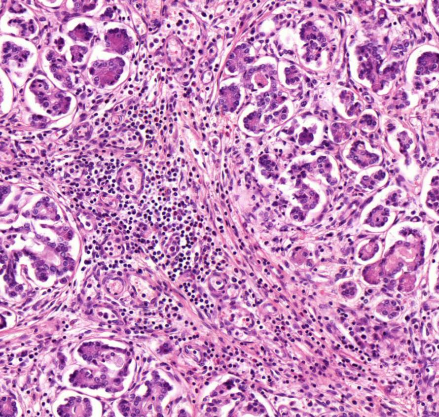 cysticus fibrosis 1