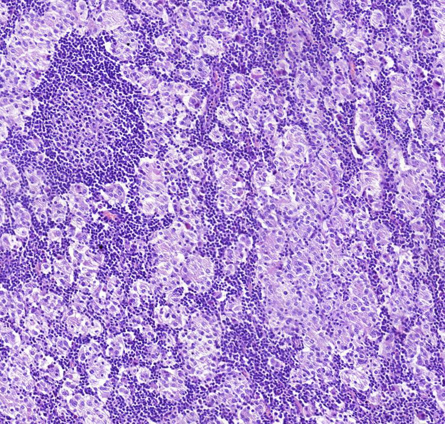 metastasis carcinomatosa lymphoglandularum folliculus + világos 