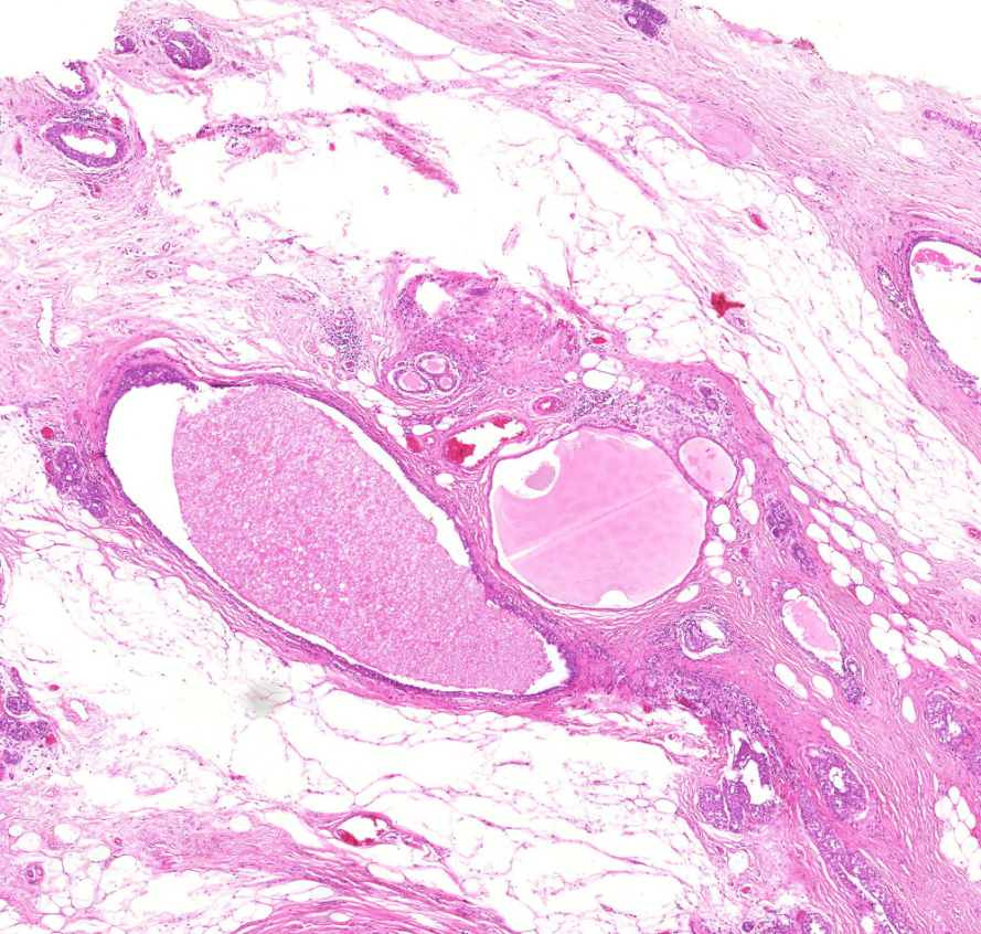 carcinoma lobulare invasivum mammae fibroysák