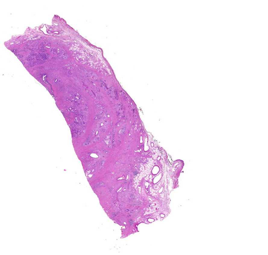 carcinoma pancreatis