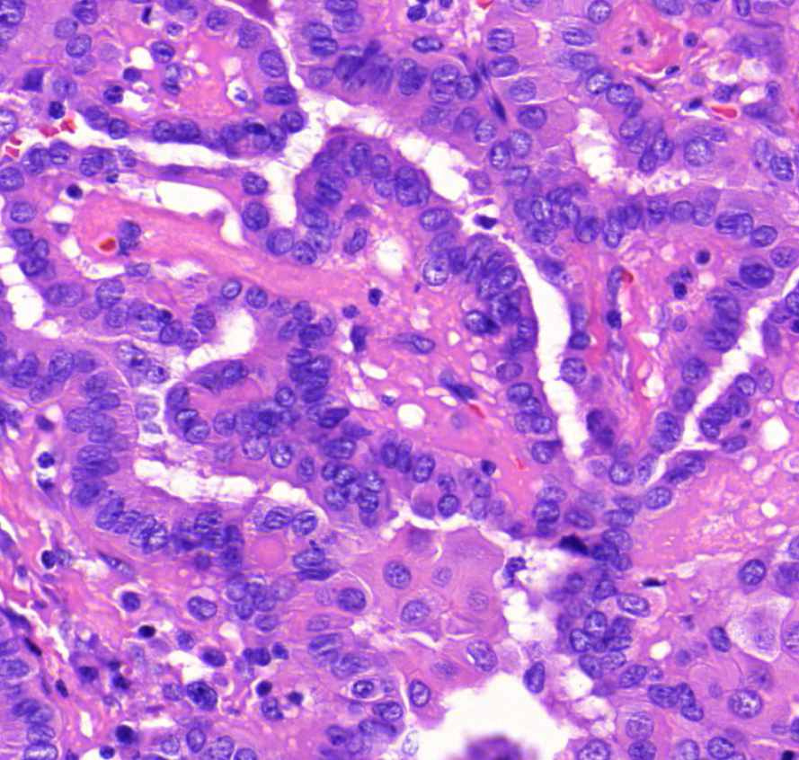 carcinoma papillare thyroideae magok tömörülése