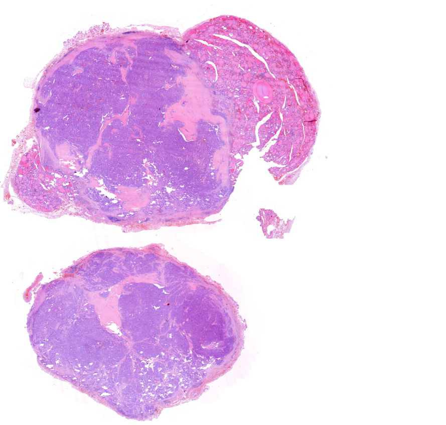 carcinoma papillare thyroideae