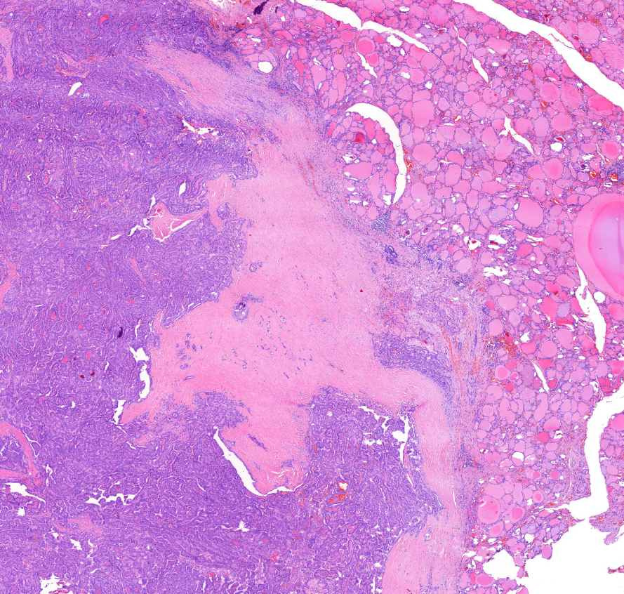 carcinoma papillare thyroideae0