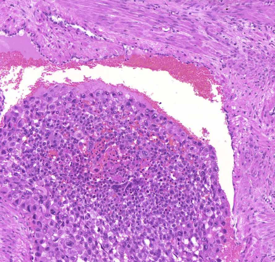 chorionepithelioma necrosis