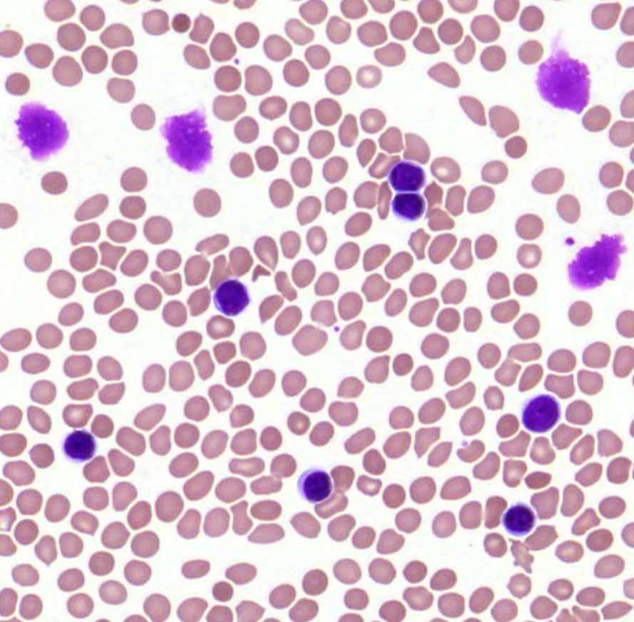 CLL - pv ly + wumprecht-rögök