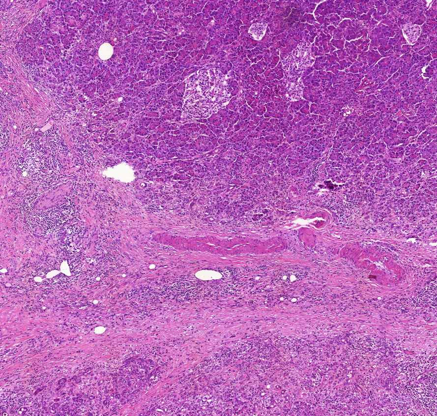 pancreatitis chronica felül norm