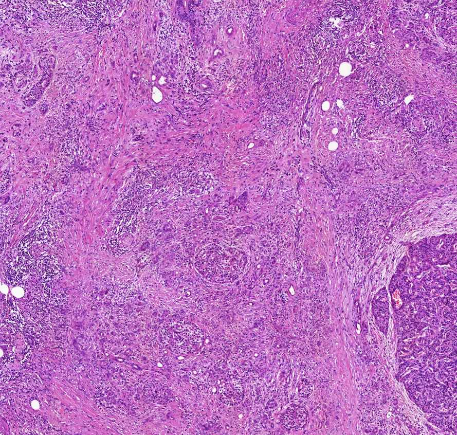 pancreatitis chronica langerhans