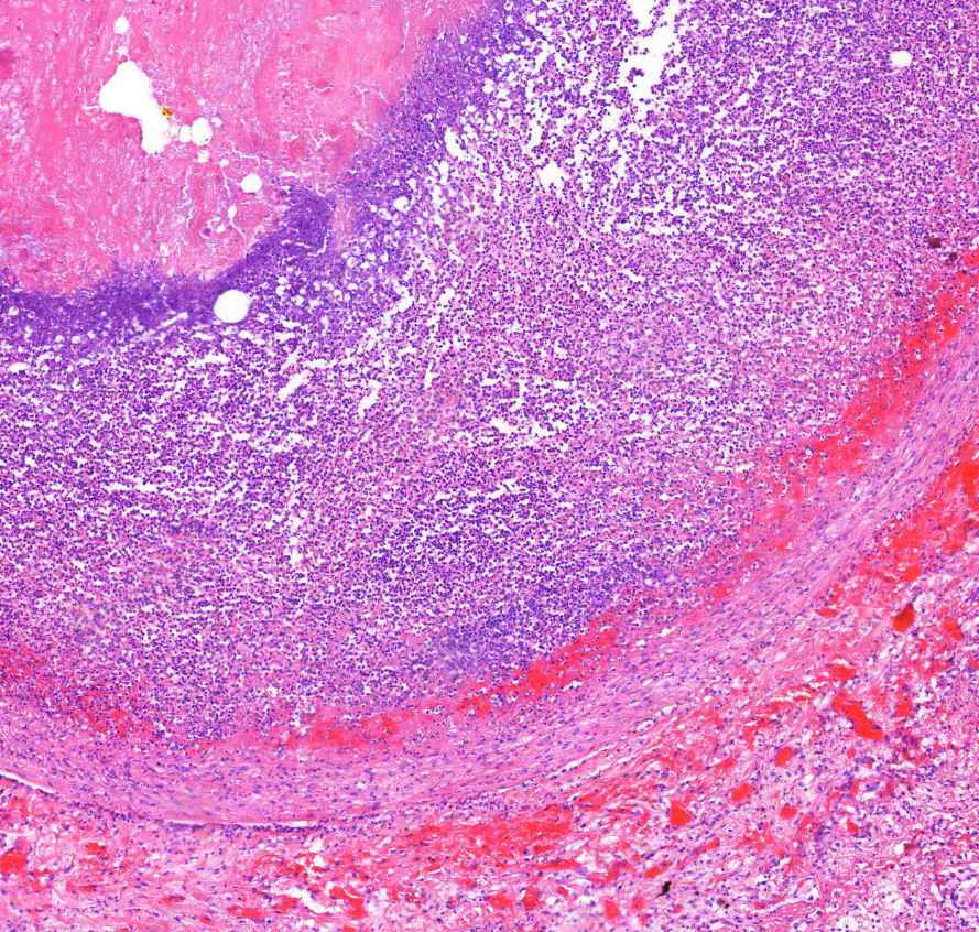 abscessus pulmonis0