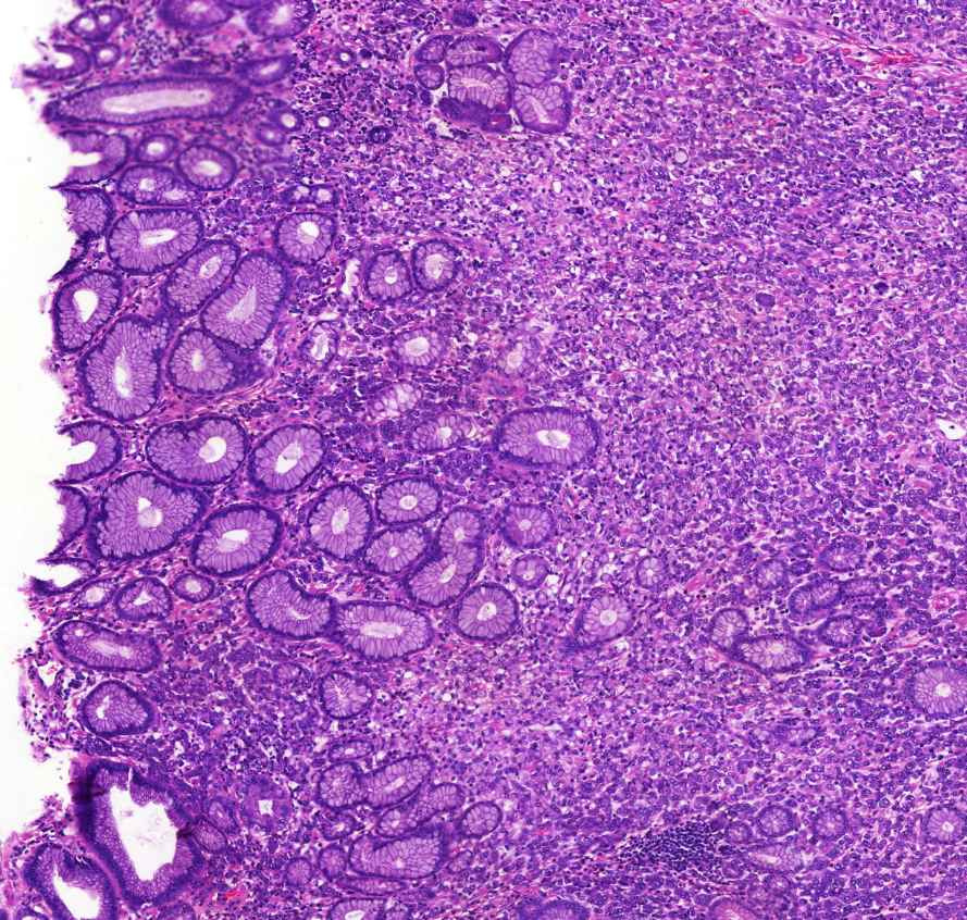 Adenocarcinoma ventriculi (diffuse type) 1