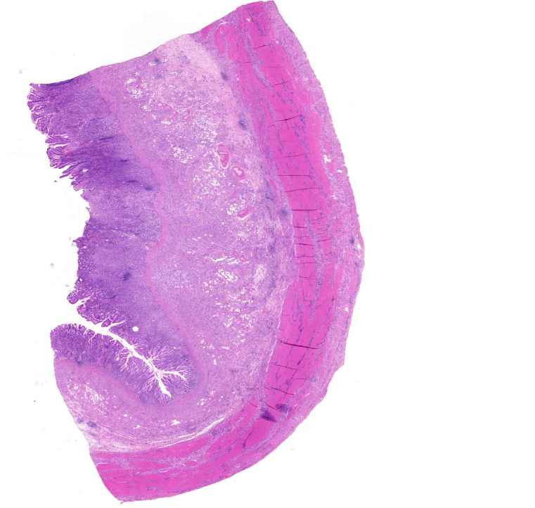 Adenocarcinoma ventriculi (diffuse type)00