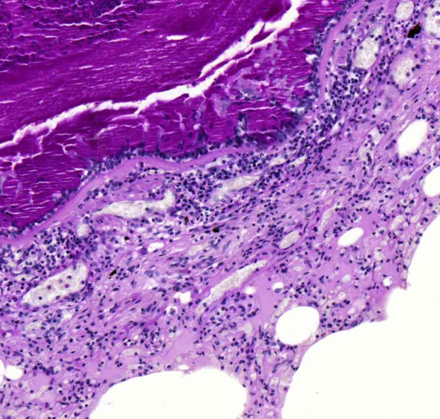 asthma bronchiale vastag hörgofal