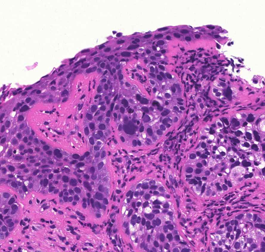 bronchus-metaplasia-dysplasia-carcinoma