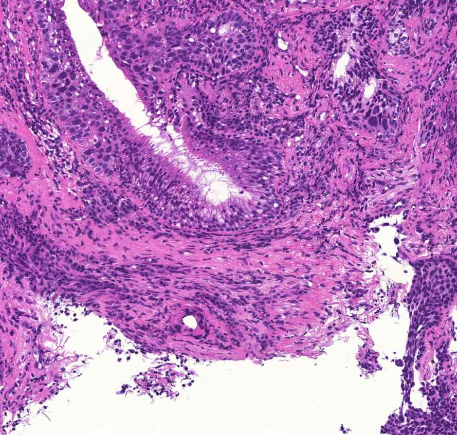 bronchus-metaplasia-dysplasia-carcinomaátmenet