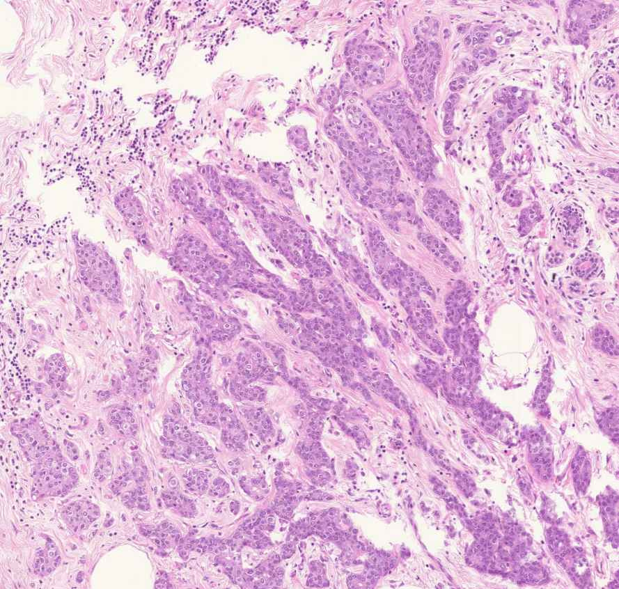 carcinoma ductale invasivum mammae kötegek