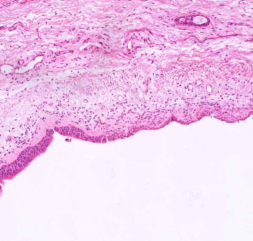 chronicus bronchitis metaplasia