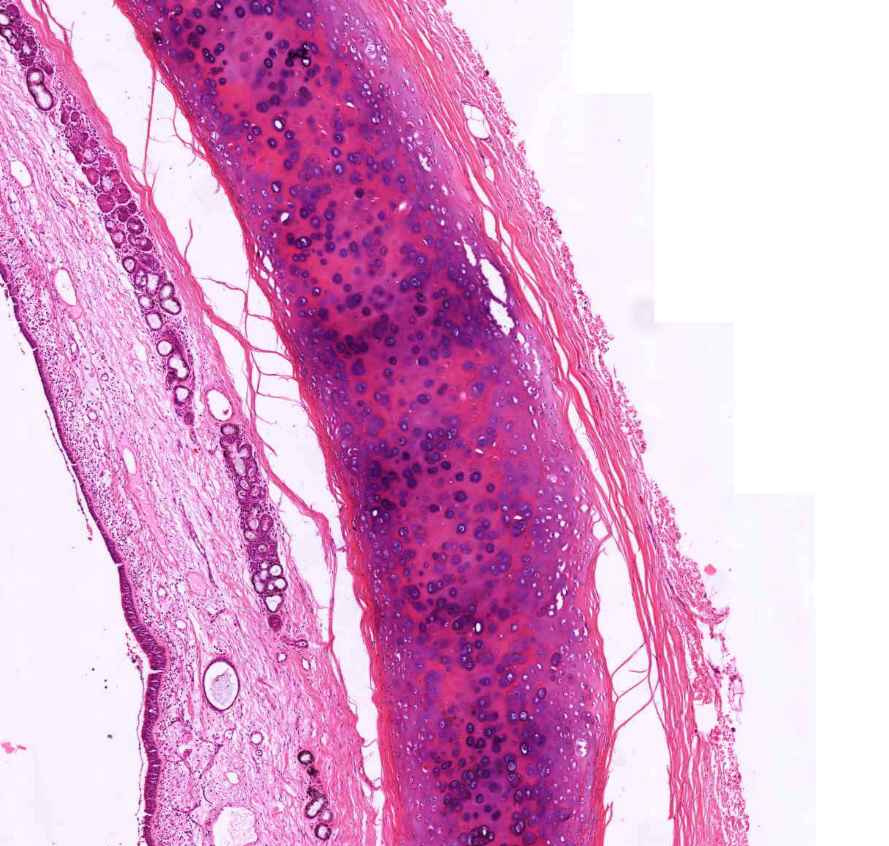 chronicus bronchitis