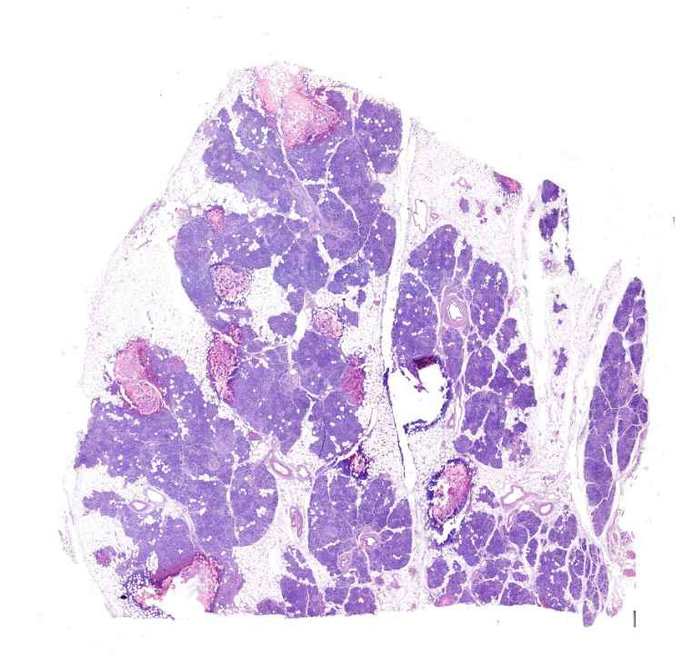 Lliponecrosis pancreatis