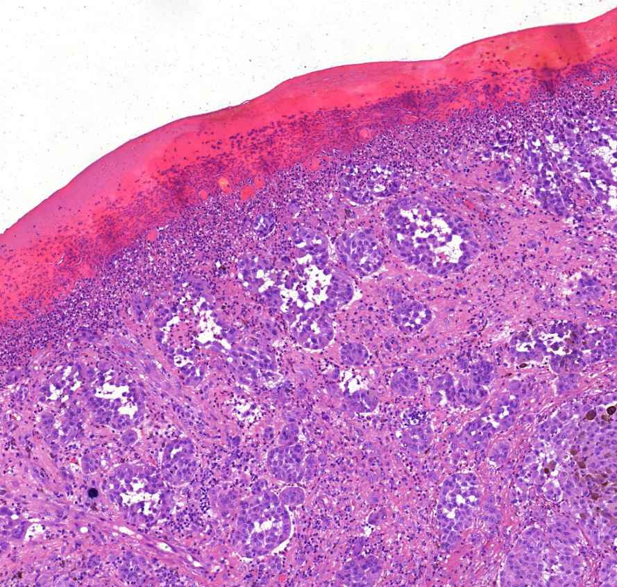 Melanoma malignum cutis0