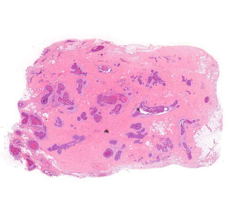 Mikrocalcification in breast cance0r