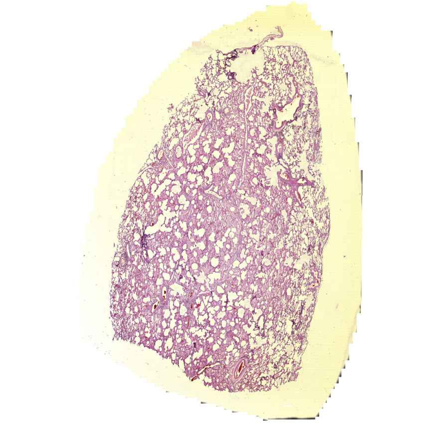 oedema pulmonis