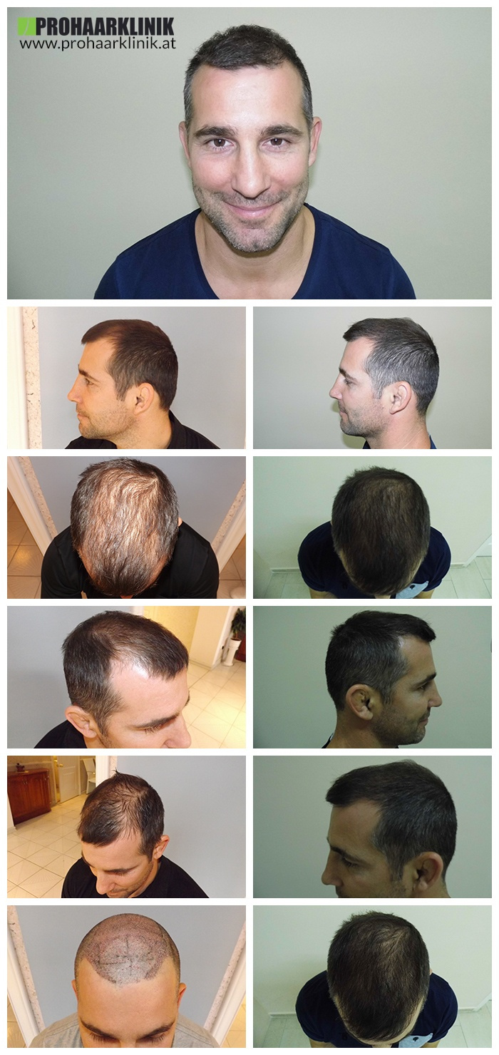 Haartransplantation für Manner - PROHAARKLINIK