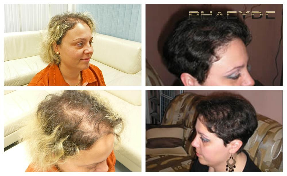 Transplante de cabelo para mulheres - PHAEYDE Clínica