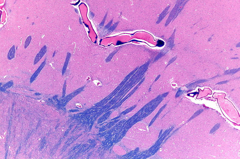 5-Globus pallidus and putamen - very low mag