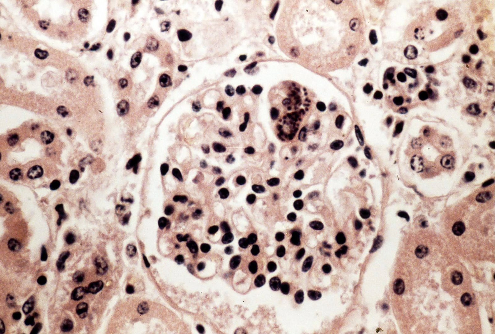 sarcocystis cruzi (Bo vese glomerulus)